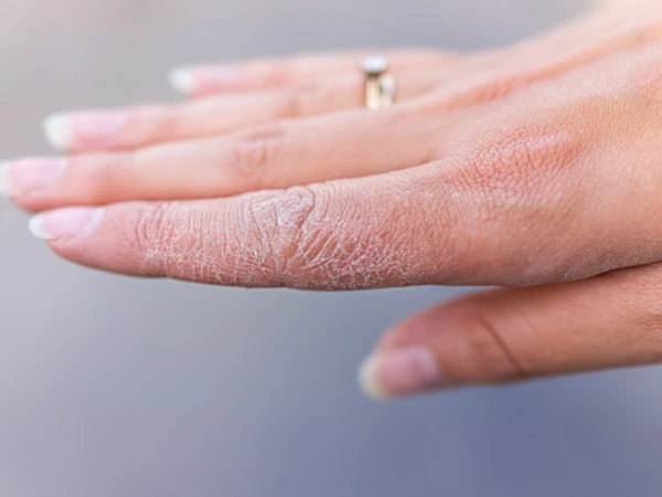 Why does skin become dry, hard, and rough in winter? What is the way to prevent it?