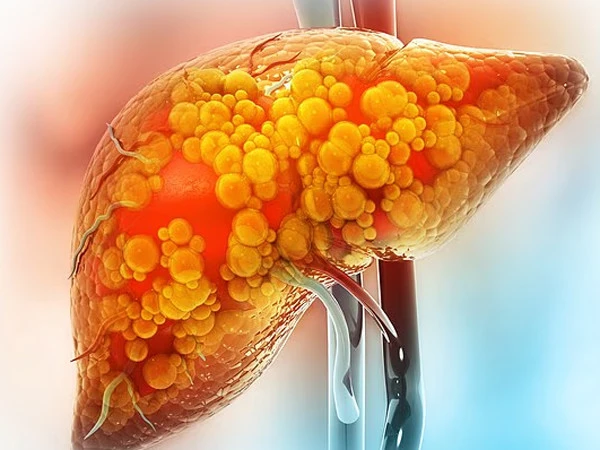 Artificial sweeteners may cause fatal liver disease: Research