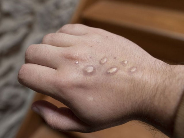 Suspected case of monkeypox emerges in Karachi