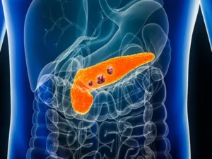 Important progress in new pancreatic cancer drug!