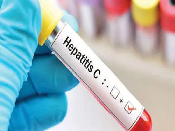 80% of Hepatitis C patients unaware of the disease, Health Minister announces free screening and treatment