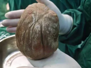 China: 1.3 kg stone removed from citizen’s stomach