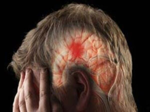 Why the risk of stroke can increase in monsoon? Experts tell important precautions